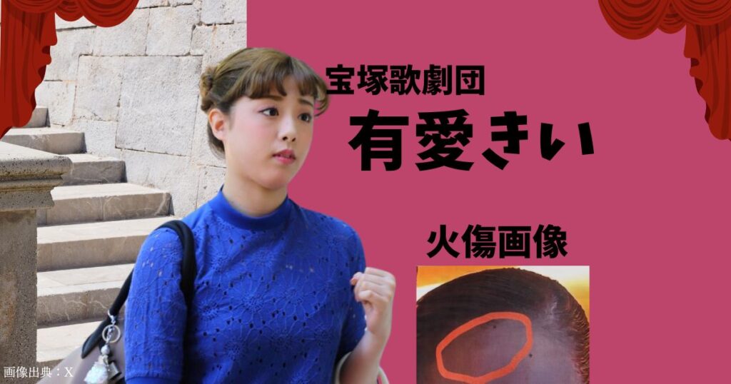 有愛きいの火傷が見づらいのでわかりやすくしてみた。